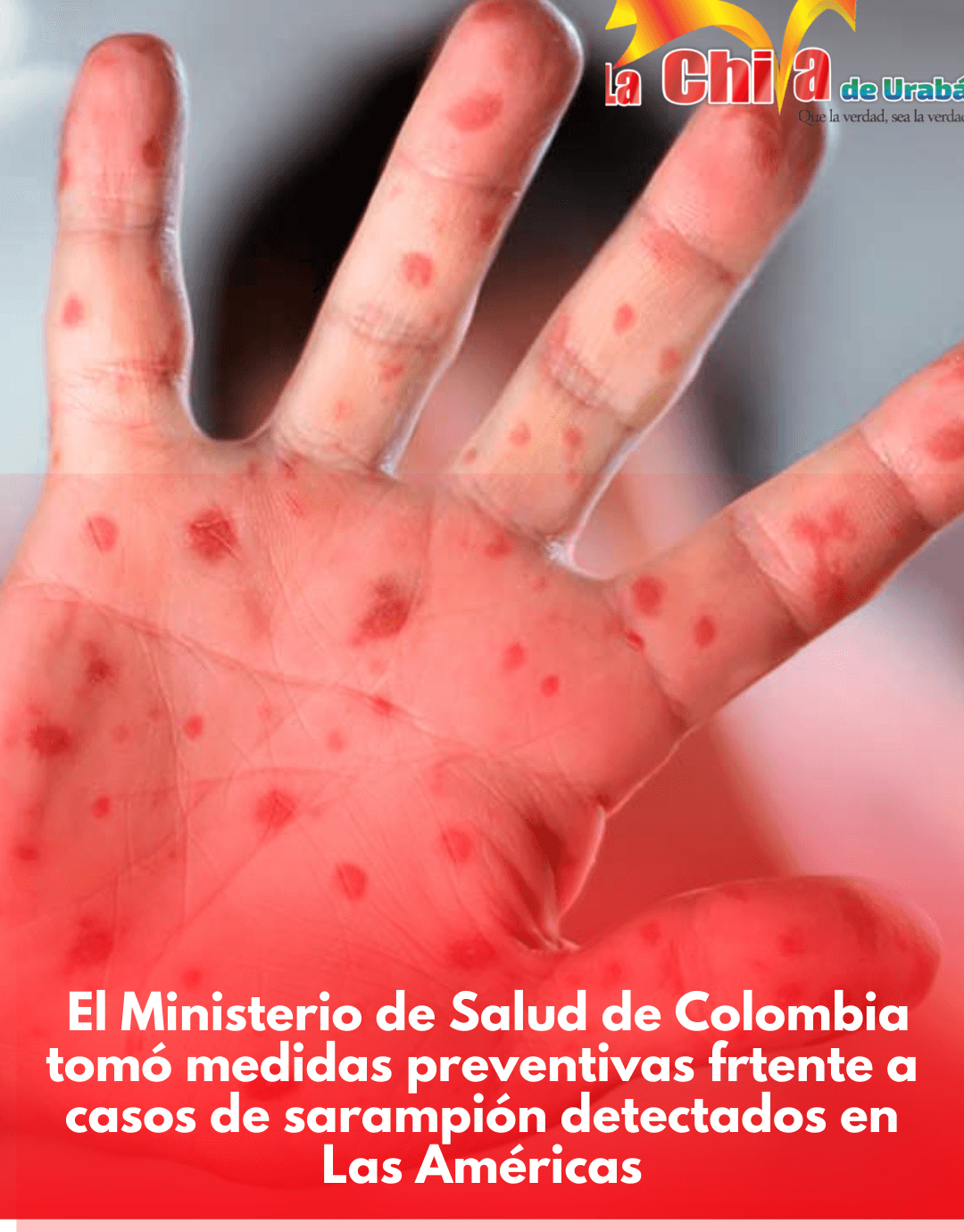 Colombia refuerza vacunación ante aumento de casos de sarampión en las Américas